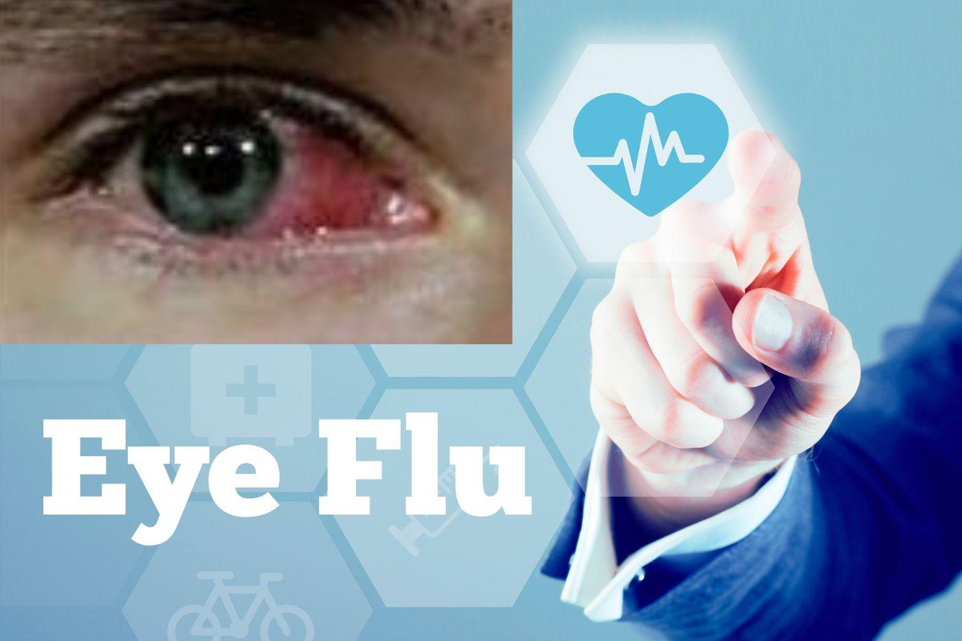 how-to-cure-eye-flu-remedies-and-tips-makfreelance